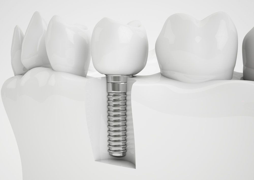 Dental implants