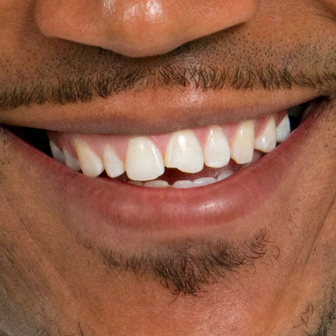 Man's chipped front tooth