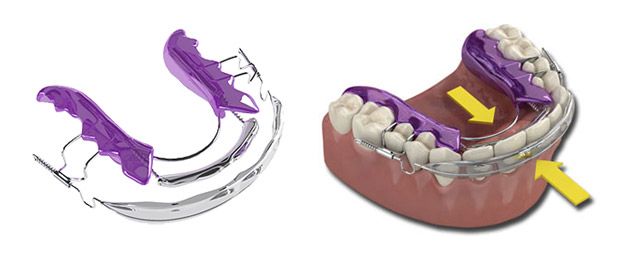 Inman Aligner