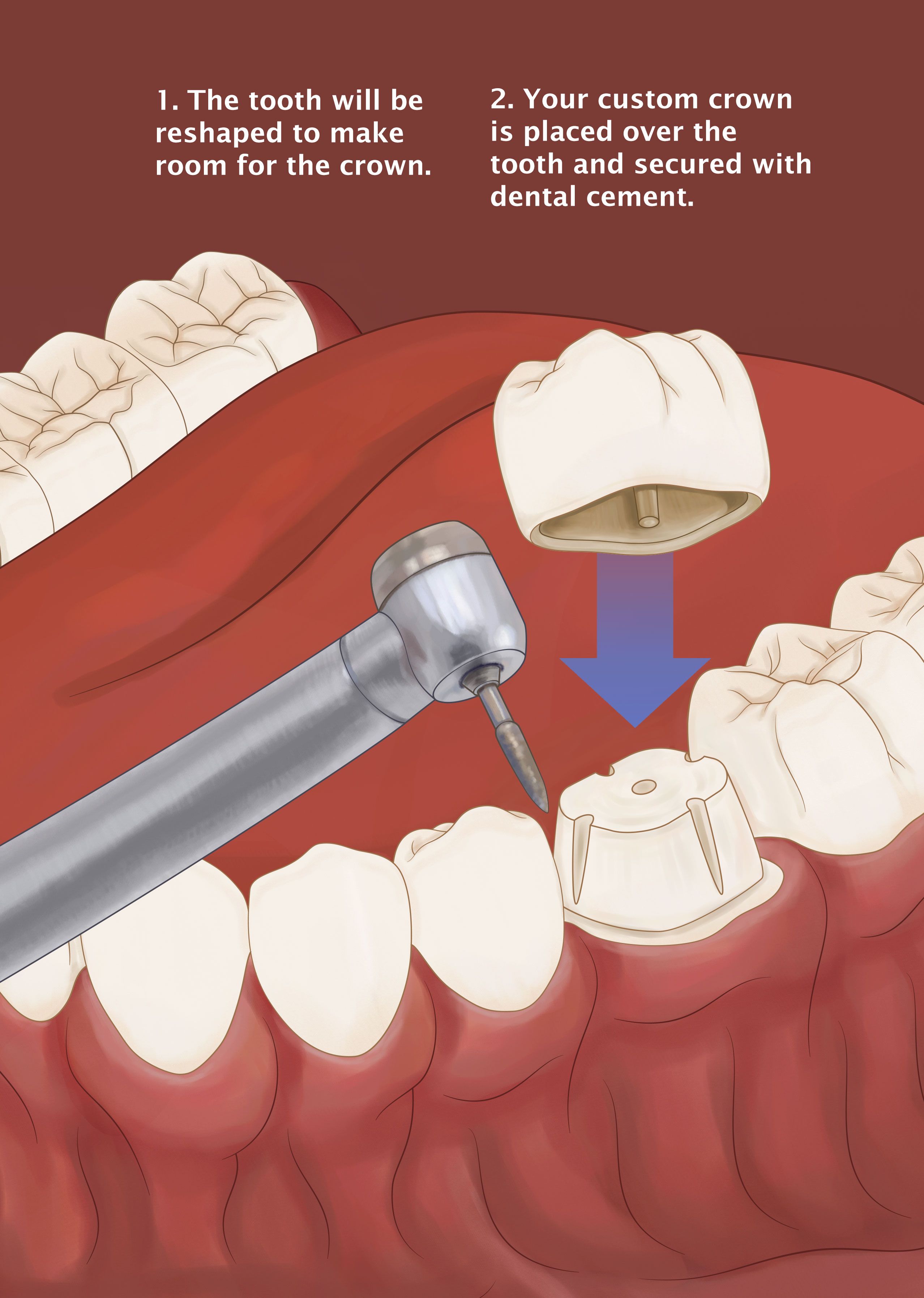 Illustration of crown placement