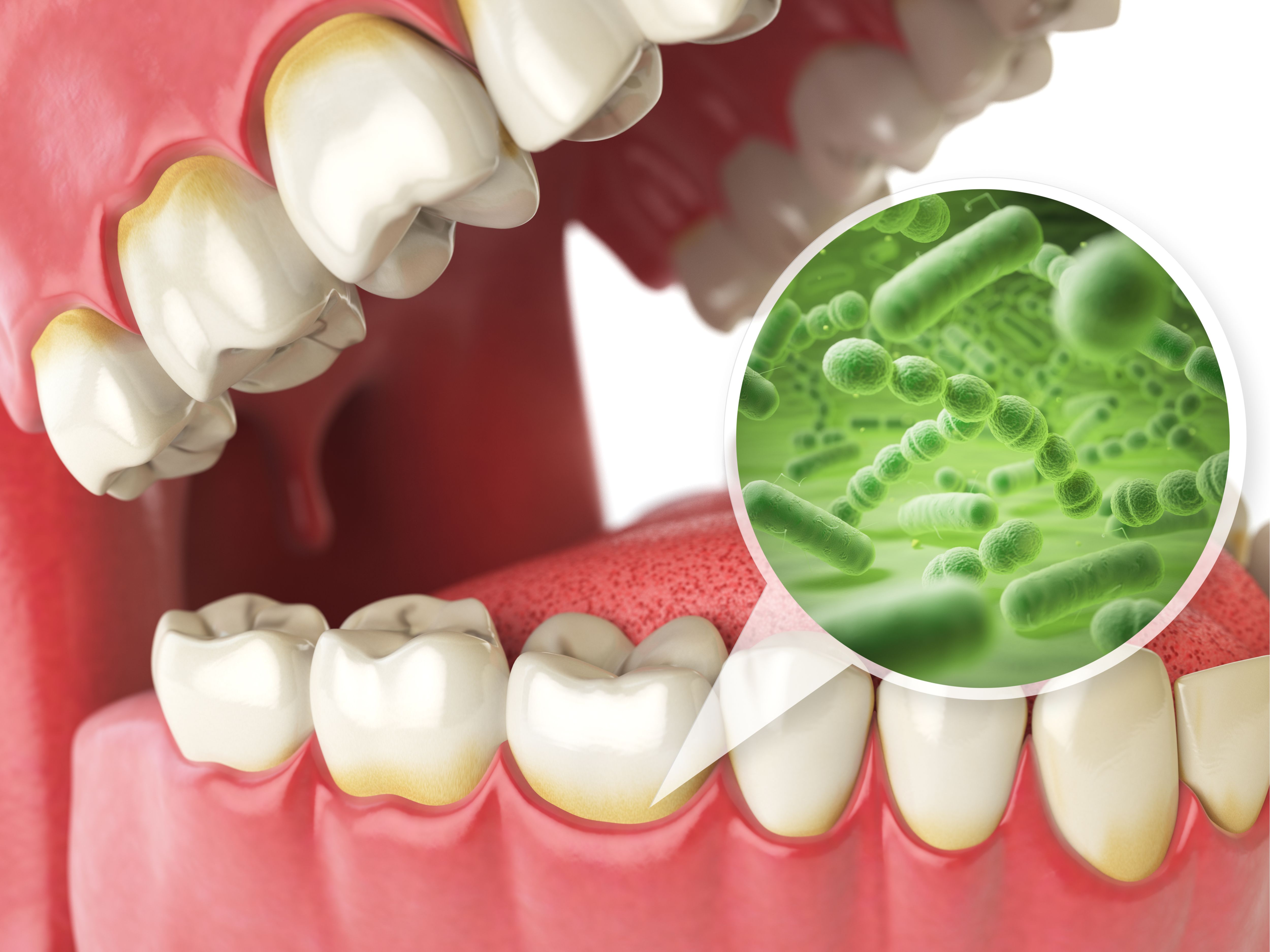 Illustration of bacteria buildup on gumline
